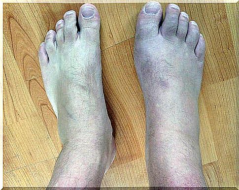 Baking soda remedies for gout