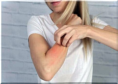 Skin rash in drug-induced photosensitivity