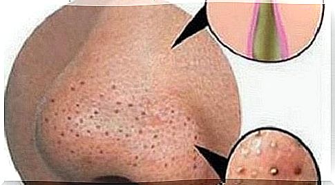 Fight pimples and blackheads naturally