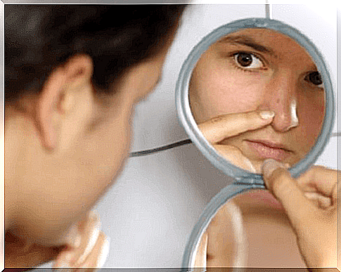 Treating blackheads and pimples