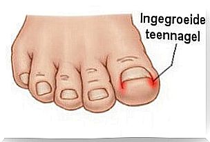 Ingrown toenail