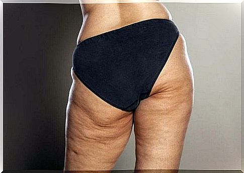cellulite is common in obese women