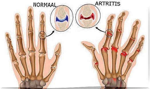 Arthritis in the Hand