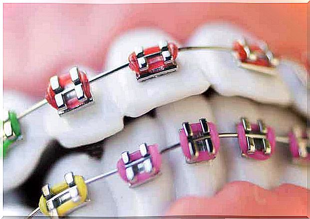 Braces with cheerful colors