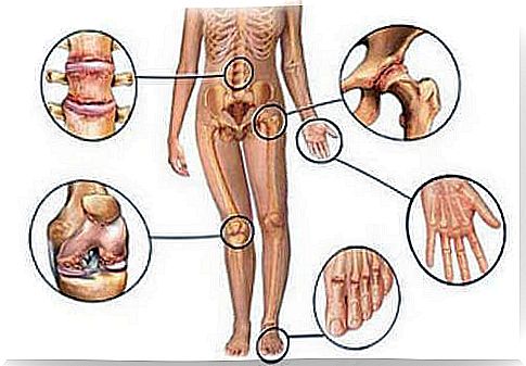 Joint pain can occur in the back, hip, knee, toe and hand