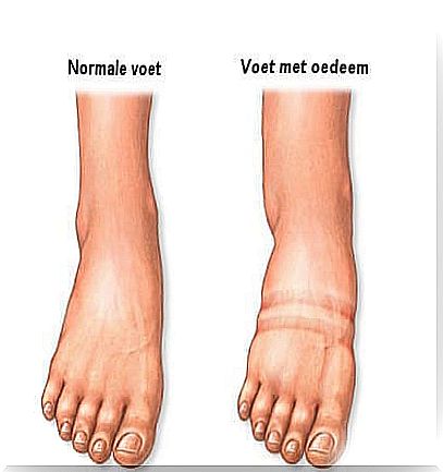 A foot with edema