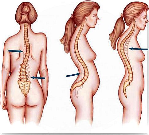 Scoliosis affects women more often
