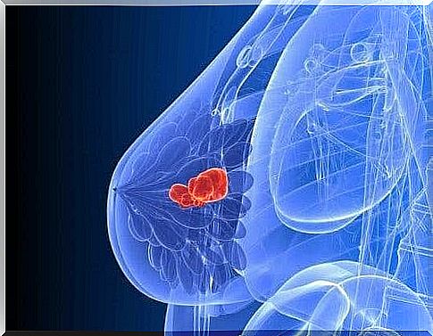 tumor in breast