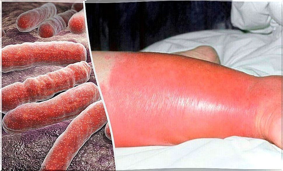 The skin infection erysipelas: problems and solutions