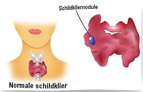 Thyroid nodules: benign or not?