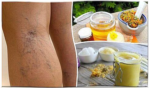 Treat varicose veins and telangiectasias with this arnica ointment