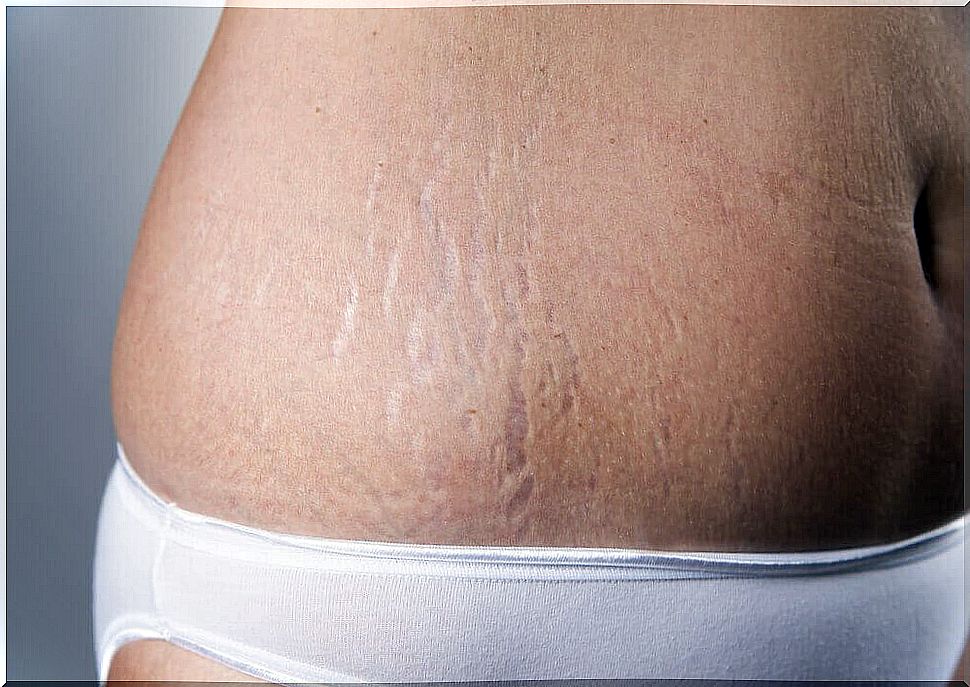 Reduce stretch marks with vitamin E