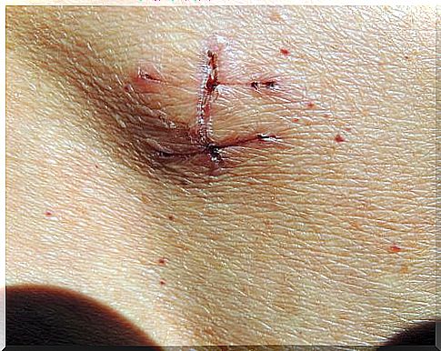 Picture of a stitched wound