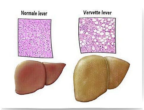 normal and fatty liver